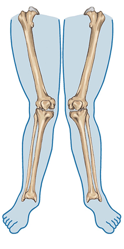 Valgus polozaj kolena ili X noge
